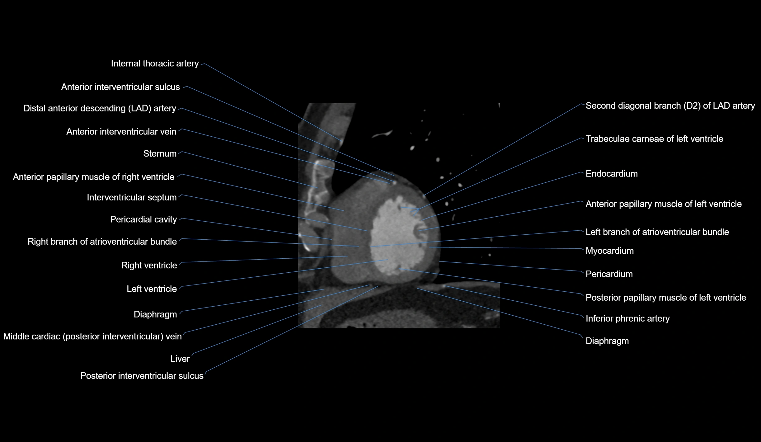 CT heart (coronary angiogram) short axis view  cross sectional anatomy labelled radiology image-00039.webp